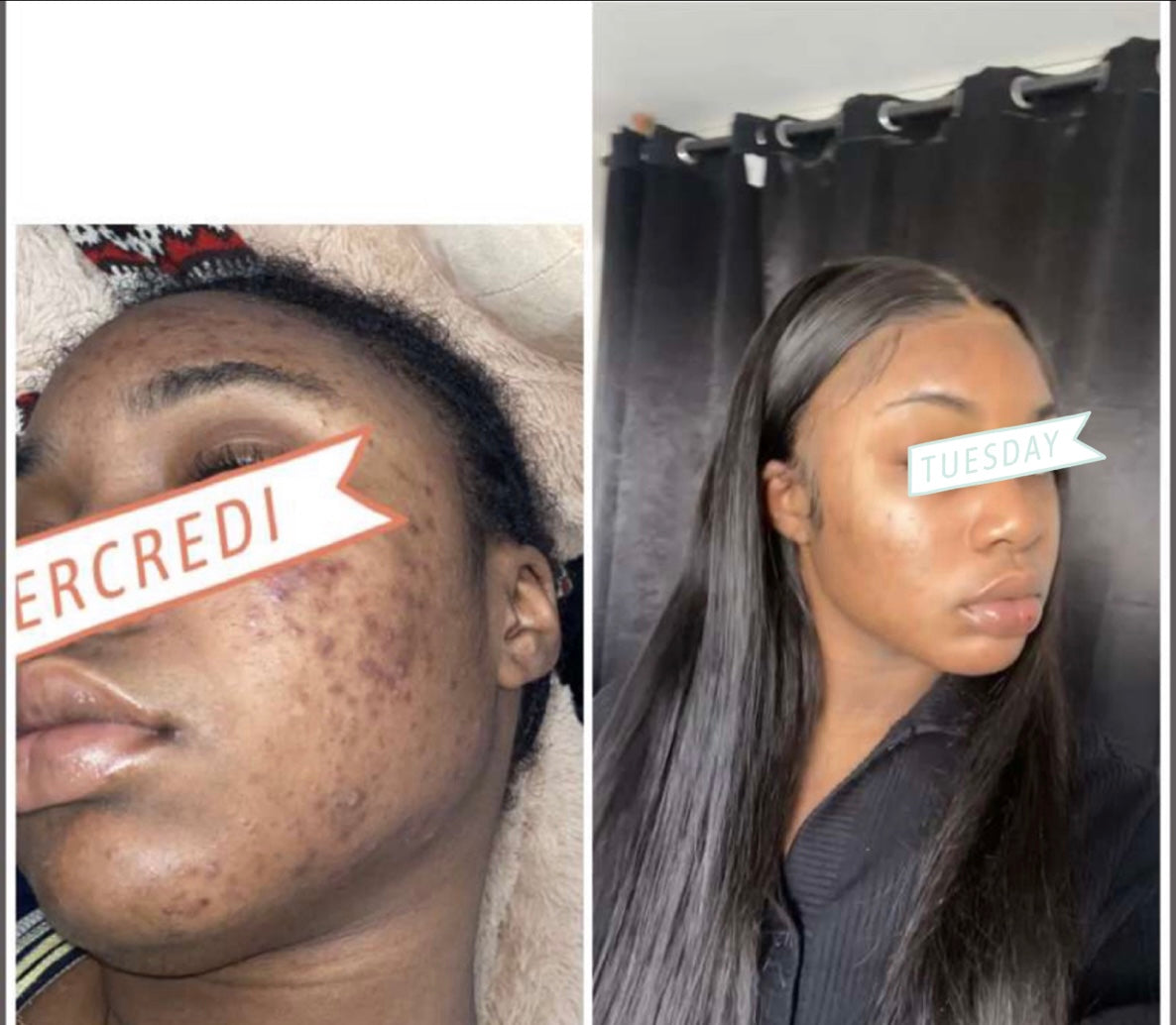 KIT VISAGE ANTI-ACNÉ